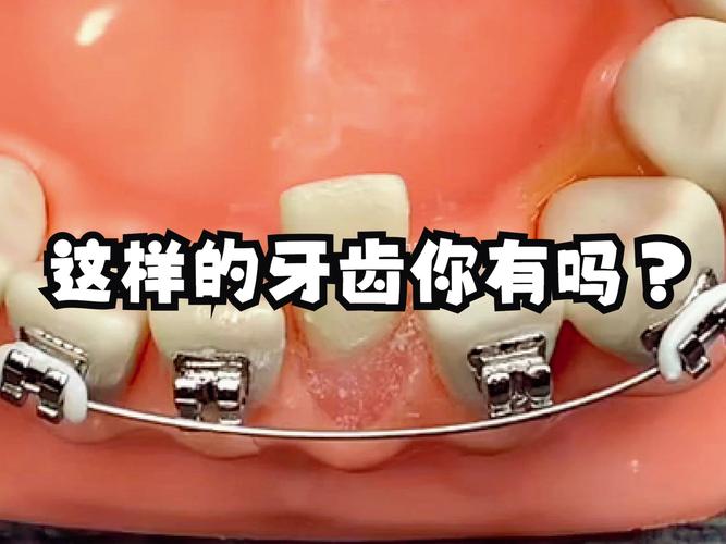 成都8岁小孩牙齿歪了能矫正吗 家长别错过最佳时机