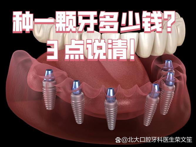 成都沈阳种牙2026年单颗多少钱?3000到5200元能搞定吗
