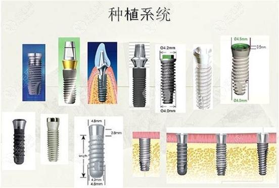 成都种植牙国产韩系欧美价格对比，哪个品牌性价比高？