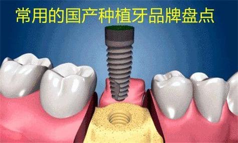 成都潍坊国产种植牙百康特多少钱一颗？