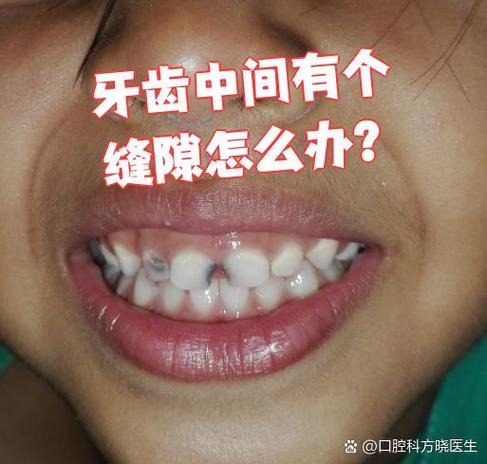 成都门牙有缝怎么矫正？这几种方法亲测有效