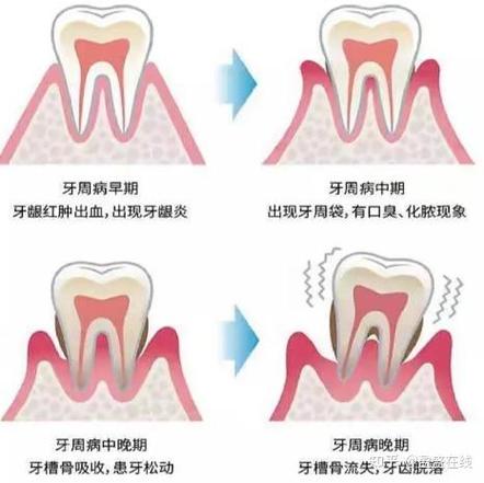 成都三十岁还能整牙吗？成人牙齿矫正必知真相