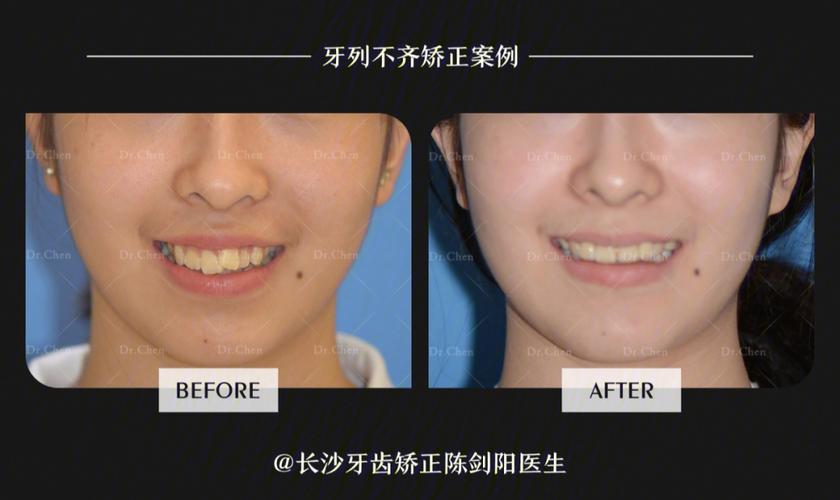 成都拔门牙矫正牙齿会松动吗？正畸医生说出大实话