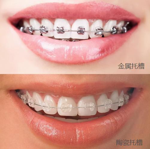成都深圳深覆合矫正价格大揭秘