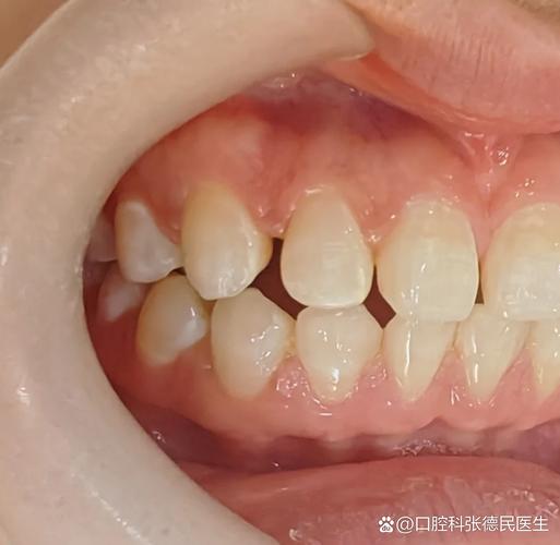 成都深圳牙缝过大矫正多少钱？最新价格一览
