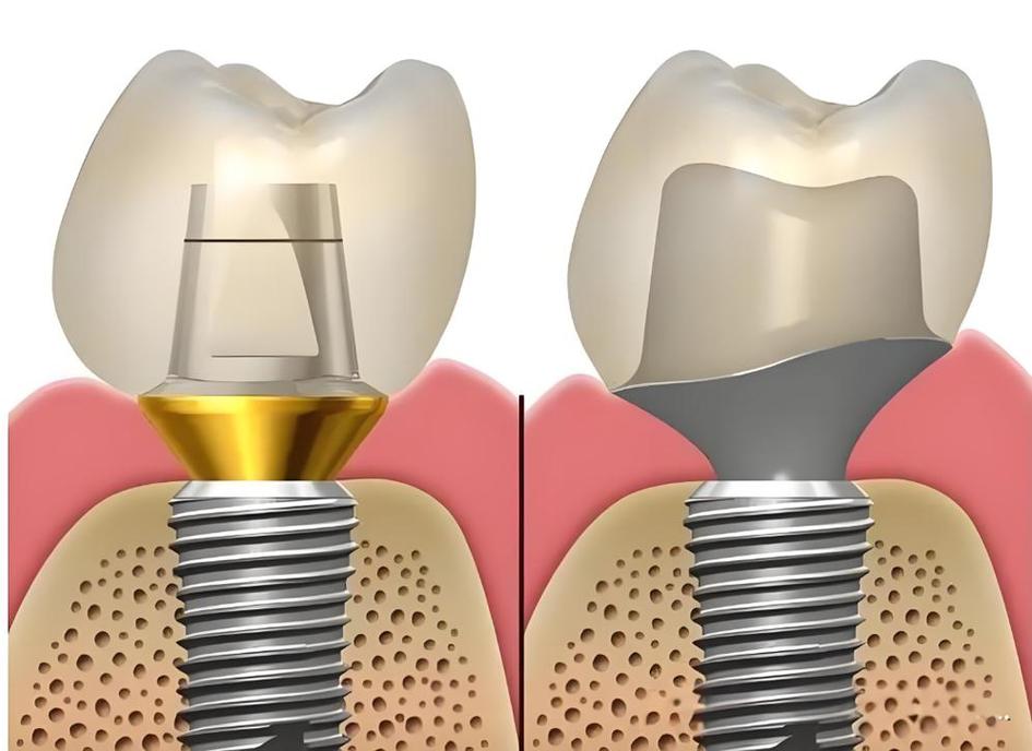 深圳宝安区哪家种植牙比较好_深圳宝安中老年半口种牙价格_深圳宝安牙科医院哪家好