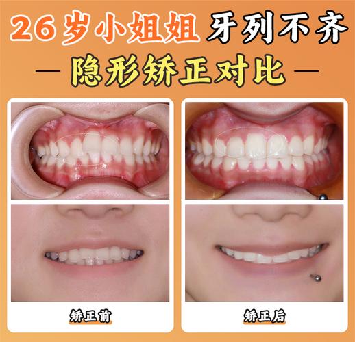 成都北京舌侧矫正靠谱吗？价格/医院/医生全揭秘