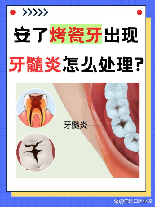 成都牙医良心忠告：做烤瓷牙前这两点不注意，当心毁了整口牙