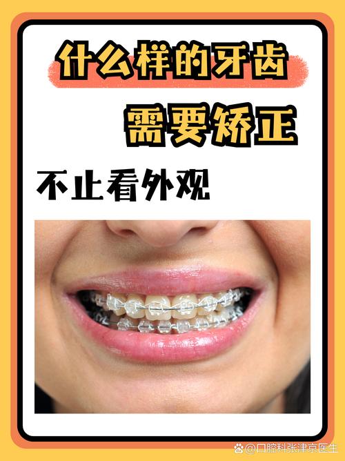 成都45岁矫正牙齿还来得及吗？过来人分享3年真实经历，成人正畸必看