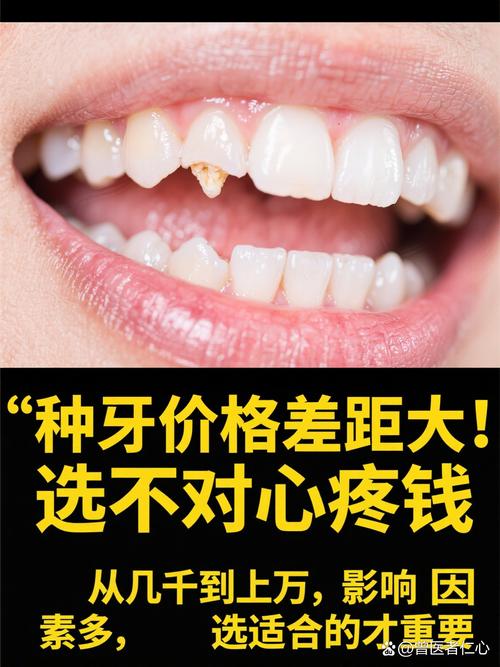 成都种植牙再等5年爆发？价格已降，技术更微创，缺牙患者有福了