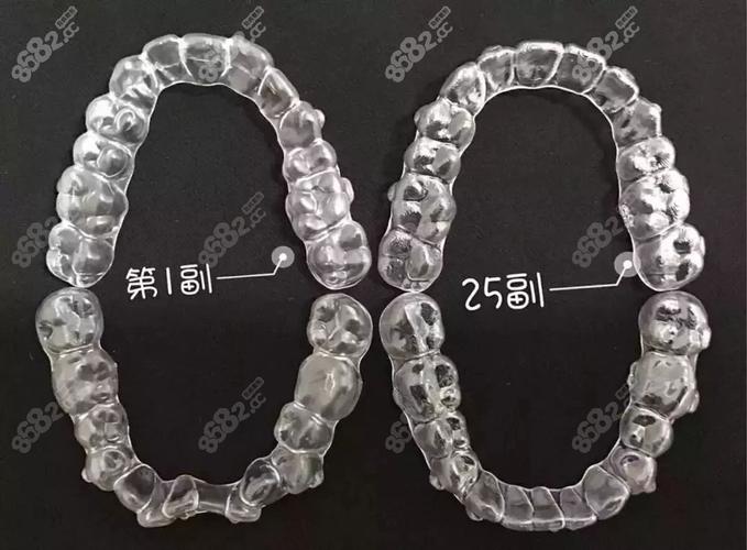 成都深圳隐适美矫正费用全公开 花多少钱心里有数