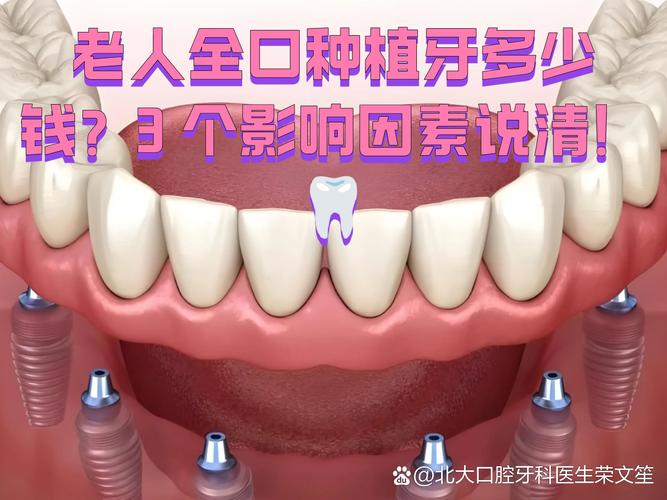 成都深圳老人全口种牙费用明细 深圳全口种植牙价格参考