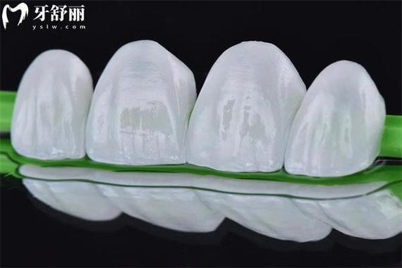 深圳牙齿贴面收费_医院牙齿贴面_在牙科牙齿贴面需要多少钱