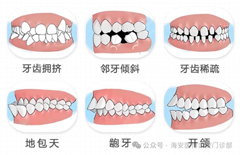 成都成人暴牙正畸要多少钱？价格全攻略来了