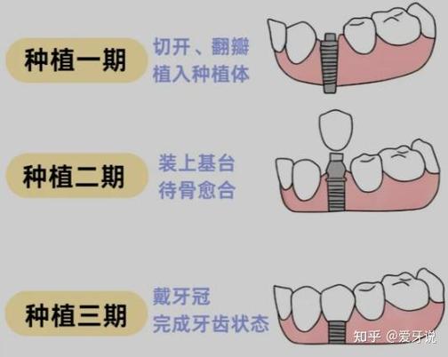 成都杭州种植牙骨粉贵不贵?要补多少?