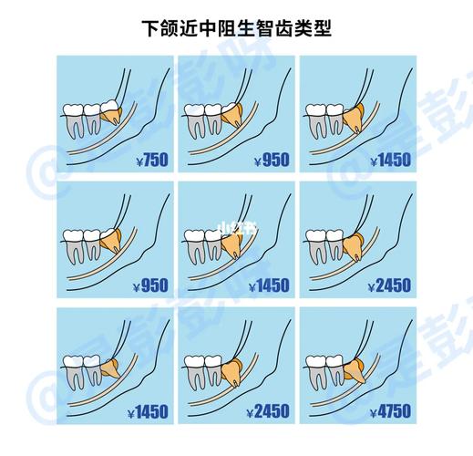成都杭州口腔医院拔牙要花多少钱？怎么选才不踩坑？