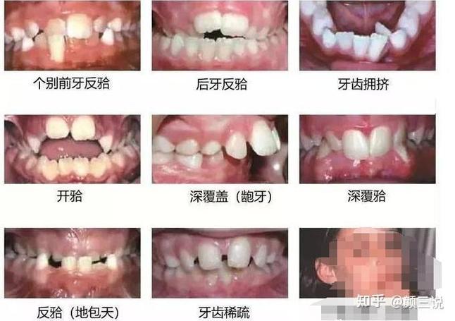 成都青岛儿童几岁做正畸最好？多少钱？