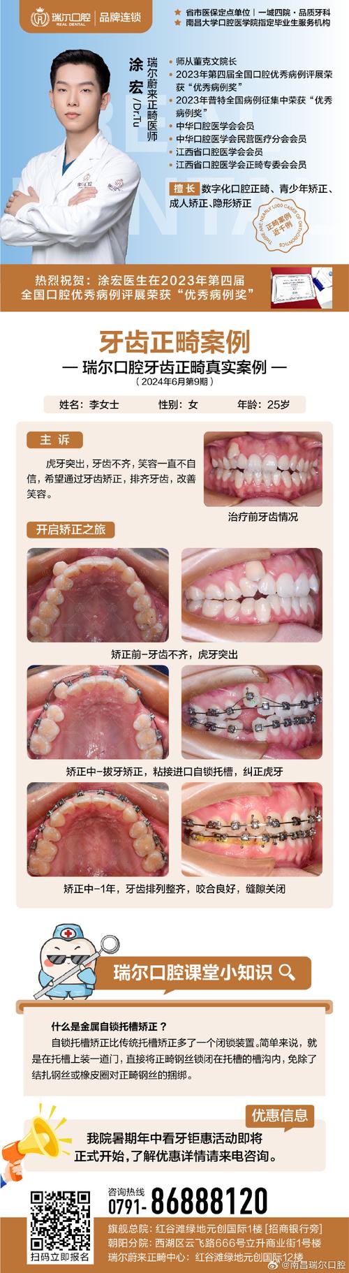 成都成人龅牙矫正选医院还是诊所？关键看医生资质和案例对比