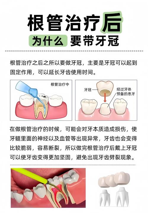 成都根管治疗补牙到底怎么回事？医生详解步骤和必要性