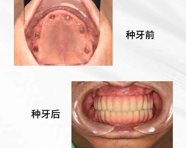 成都2026种植牙适合哪些人 这些禁忌要提前了解