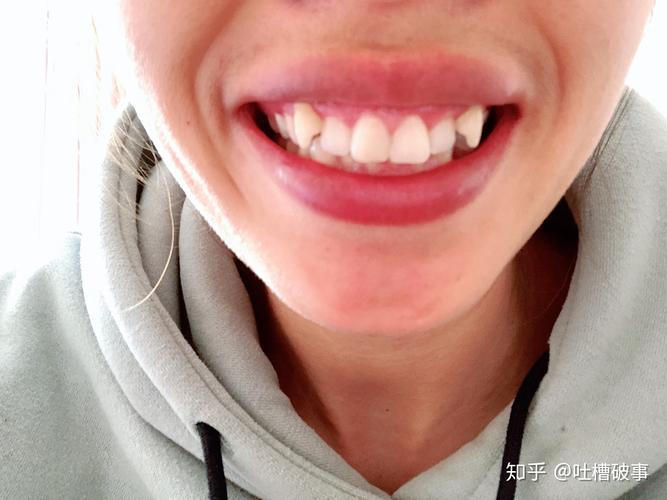 成都虎牙想要快速矫正?攻略这里给你讲明白