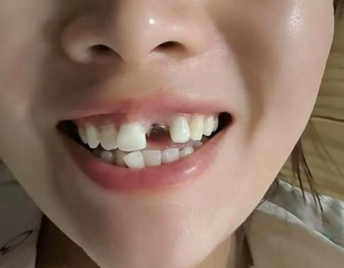 成都七旬老人种牙靠谱吗？看完这篇就明白