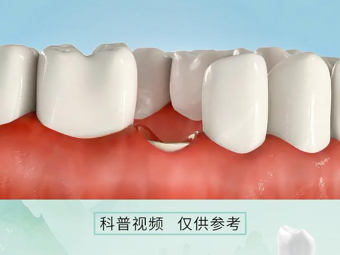 成都福田区根管治疗后必须做牙冠吗