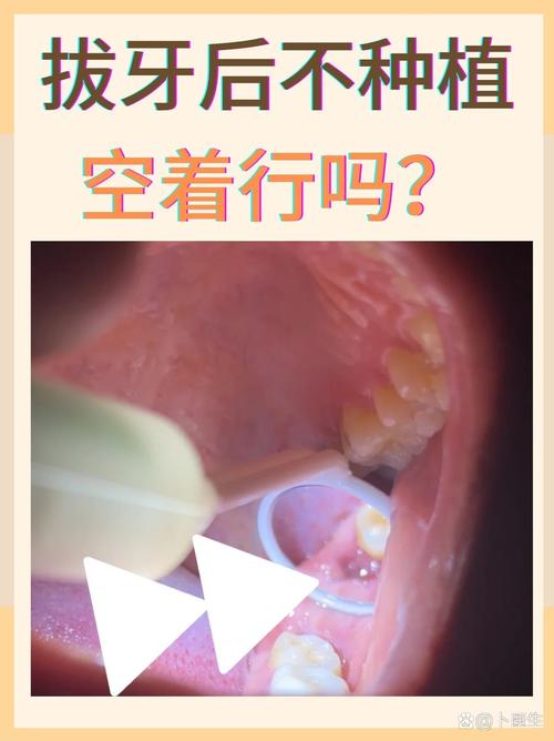 成都成人拔牙后必须种牙吗？不种牙的后果，医生告诉你真相
