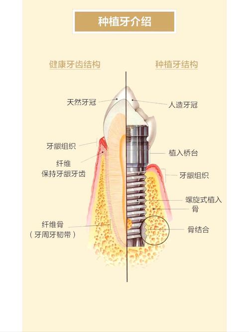 成都什么叫种植牙齿 一篇讲清原理过程