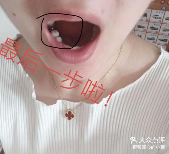成都宝安新安种植牙哪家医院好?真实体验告诉你