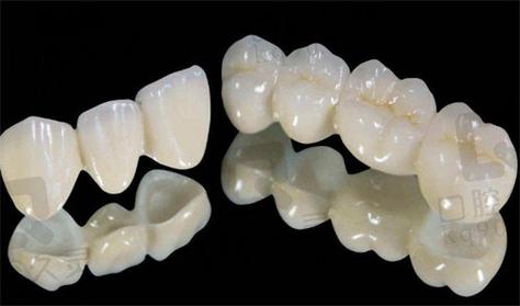 成都深圳全瓷牙哪家牙科好 真实经验分享