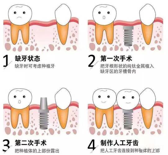上海种植牙过程_上海牙种植过程视频_上海种植牙费用