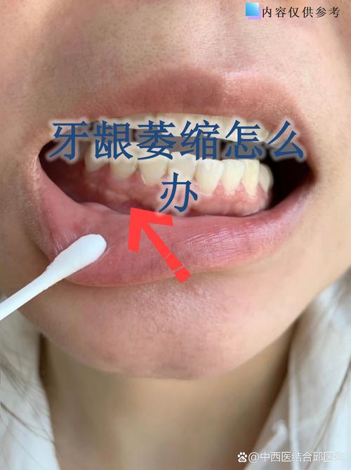 成都缺牙不补的严重后果：邻牙倾斜松动，对牙伸长，牙槽骨萎缩