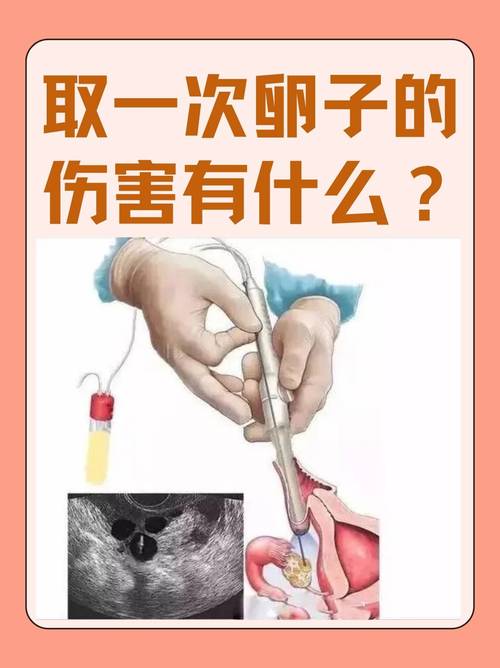 成都取卵麻醉到底疼不疼 会不会影响卵子质量 医生一次说清
