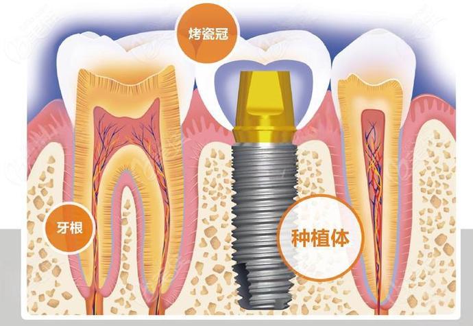 成都赤峰种牙费用详解:从预算到效果,给您的实惠指南