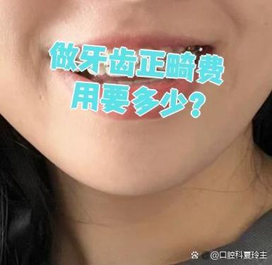 成都深圳福田青少年钢丝矫正牙齿要花多少钱