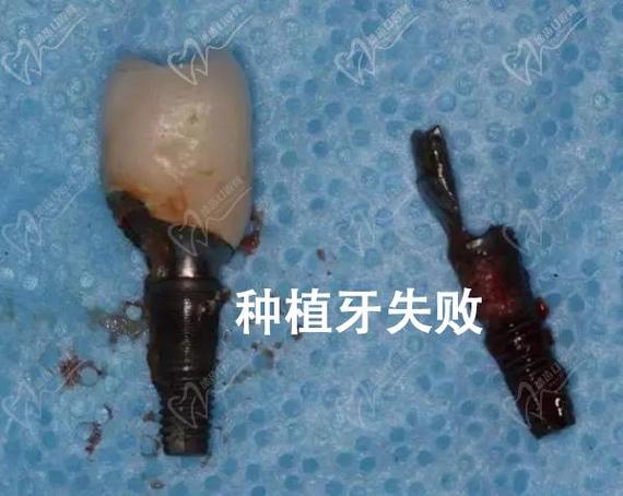 成都种植牙失败了怎么办？修复费用到底要多少？