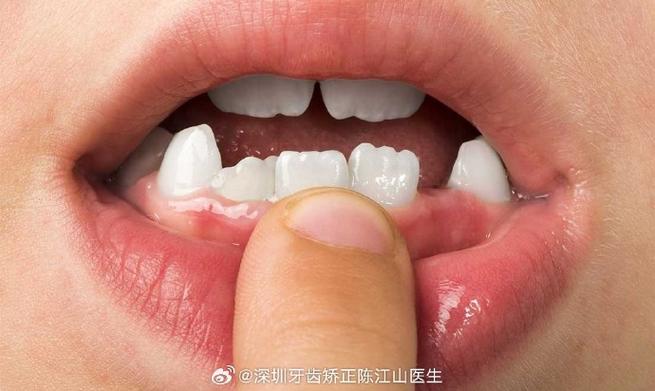 成都小孩牙齿长成锯齿状，到底严重不严重？