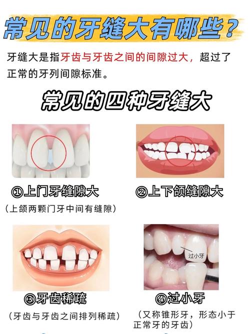 成都矫正牙齿门牙缝隙变大了？医生告诉你正常吗咋应对