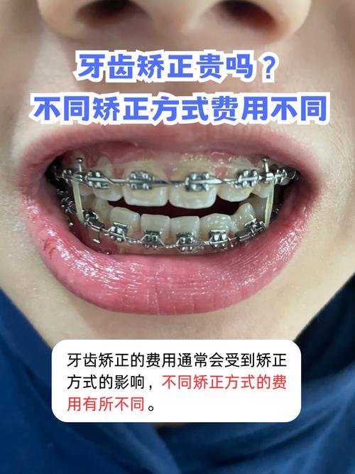 矫正牙齿舌系带多少钱_牙齿矫正舌系带手术_舌系带矫正术有什么风险吗