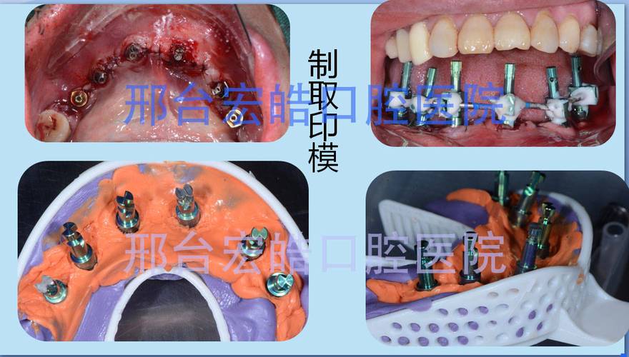 牙齿怎么种植_牙齿种植步骤和流程_牙齿种植价格一般多少钱一颗