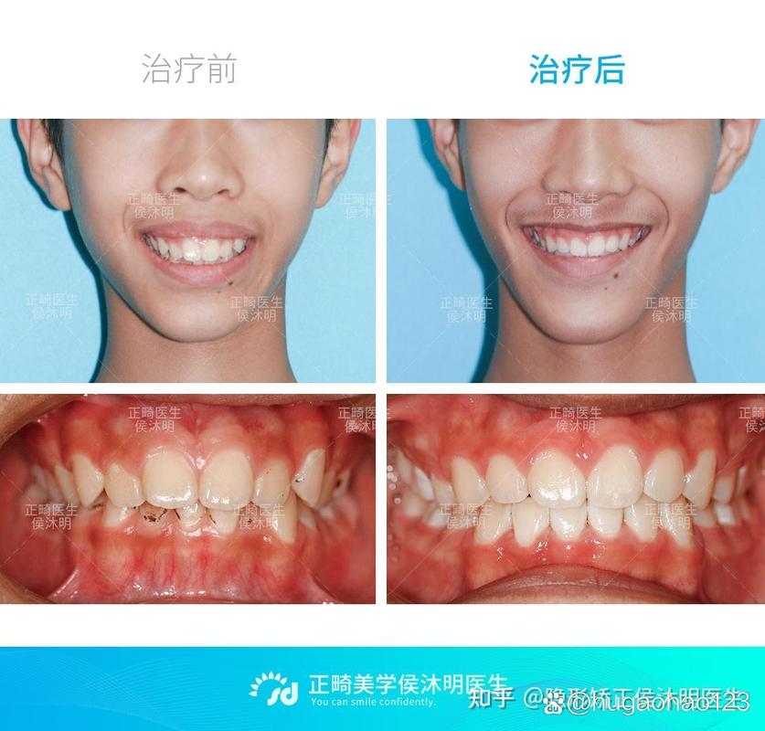 成都25岁龅牙还能矫正吗?过来人分享真实经历