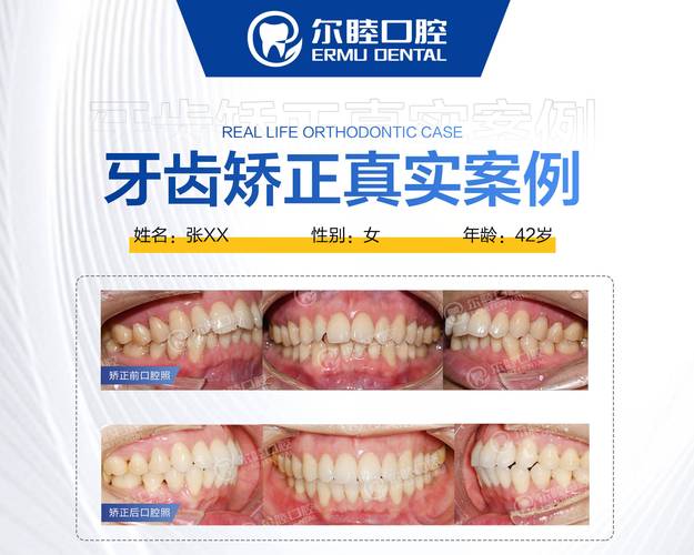 成都深圳宝安换牙矫正多少钱？最新费用参考来了