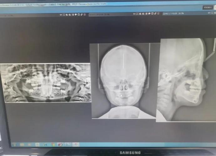 成都幼儿地包天矫正要花多少钱？费用明细来了