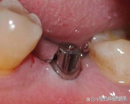 罗湖种牙哪里最好_罗湖医院种一颗牙要多少钱_深圳罗湖骨量不足全口种牙费用