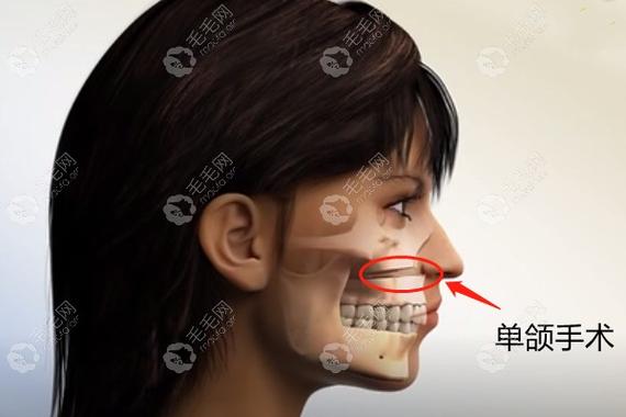 成都深圳成人骨性龅牙矫正到底要花多少钱?
