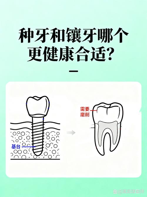 成都25岁镶牙还是种牙好?别磨坏好牙,年轻人种牙是长期投资