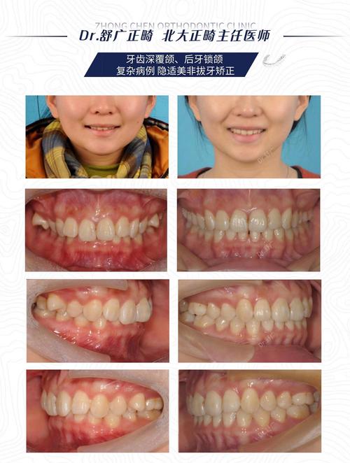 成都30岁后矫正深覆合？成人正畸完全可行