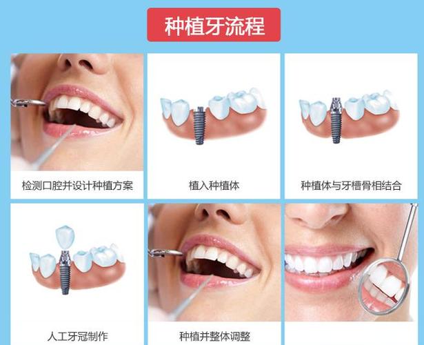 成都深圳罗湖骨量不足全口种牙多少钱？费用明细来了