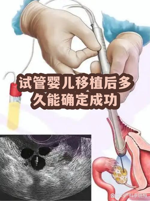 成都一代试管婴儿能成功吗 看完心里有底